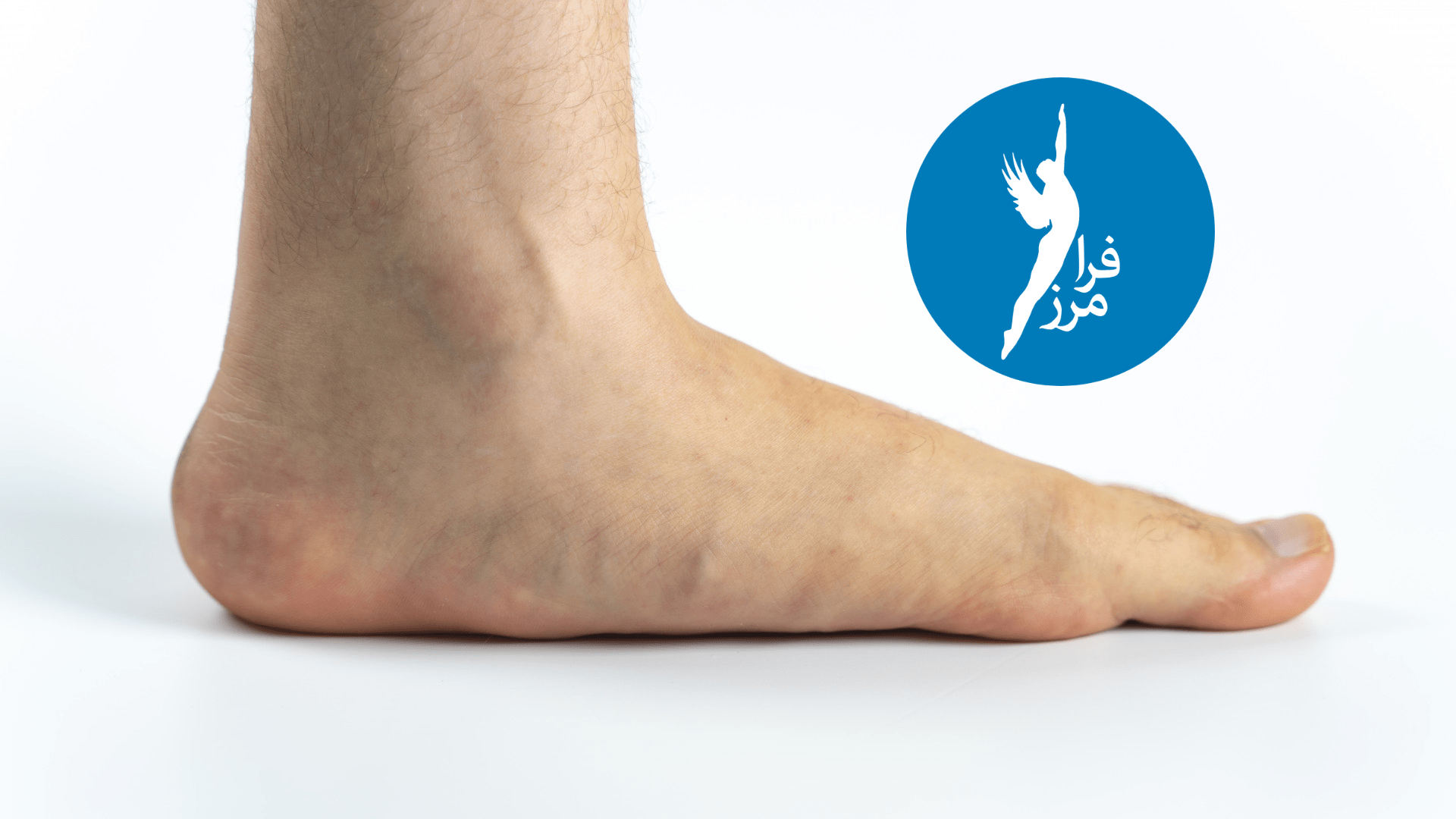 کمر درد دارید؟ شاید به عارضه کف پای صاف مبتلا هستید!