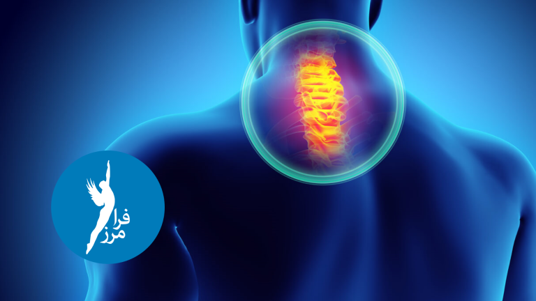 آرتریت گردن چیست و برای پیشگیری و کنترل یا درمان آن چه باید کرد؟
