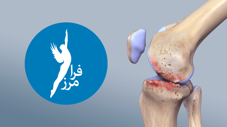 با پدیده آرتروز آشنا شو