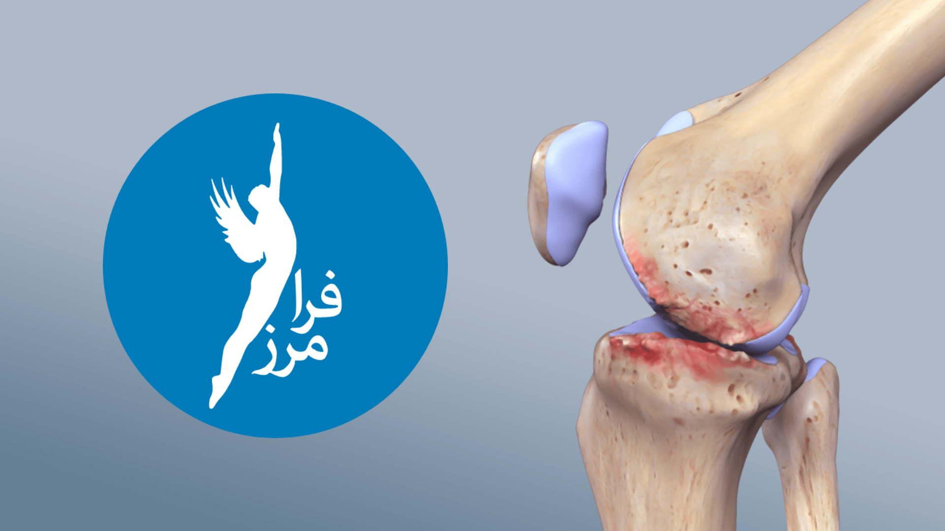 با پدیده آرتروز آشنا شو