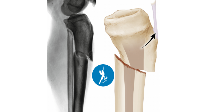 شکستگی شفت تیبیا چیست و چگونه بهبود میابد؟