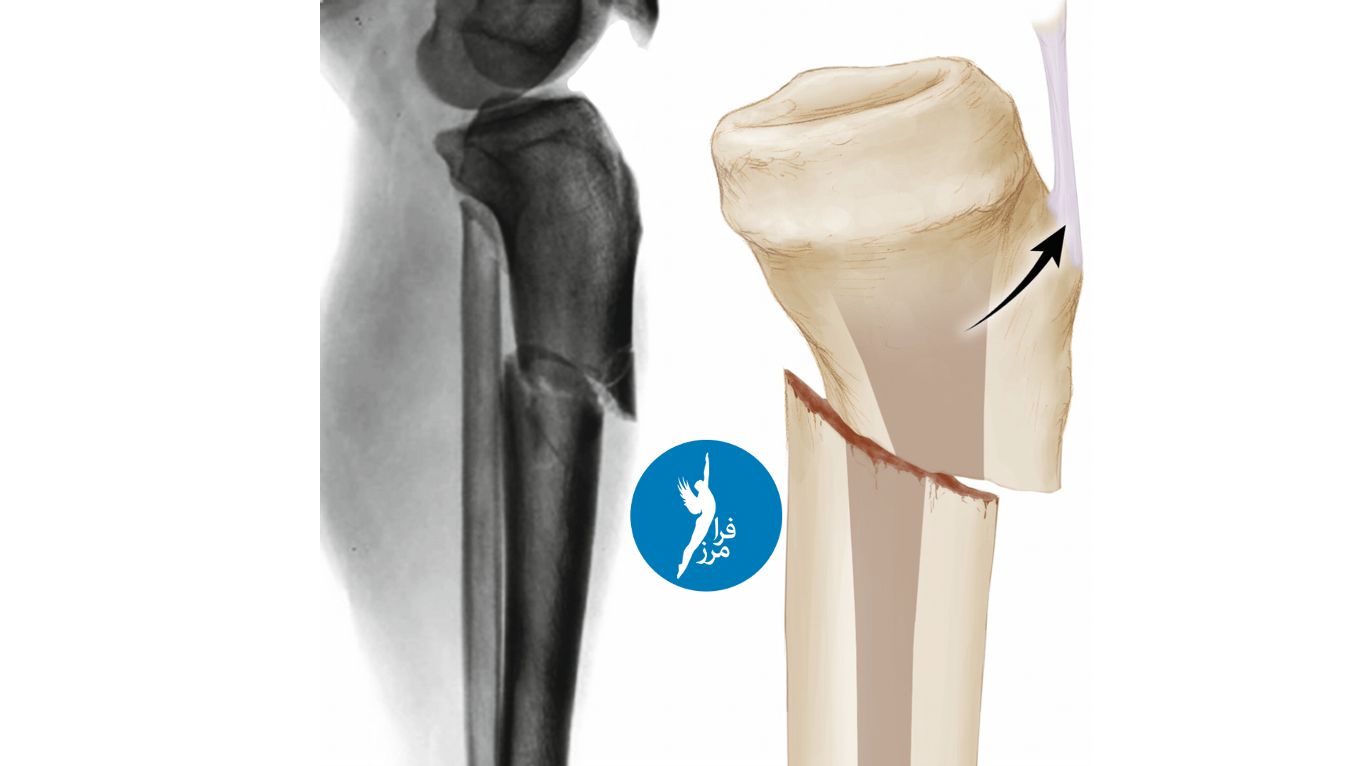 شکستگی شفت تیبیا چیست و چگونه بهبود میابد؟