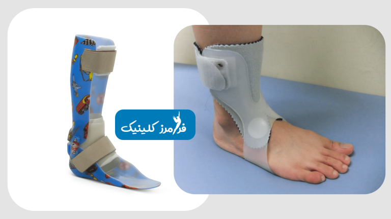 آشنایی با ارتز فعال مچ پا یا آتل مچ پا