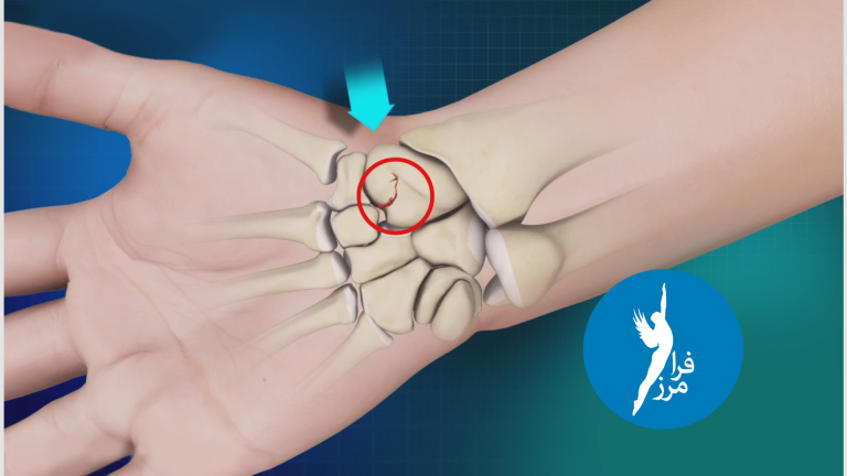 شکستگی اسکافوئید در مچ دست چیست؟
