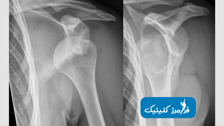 در رفتگی شانه چیست و چه موقع اتفاق می افتد?