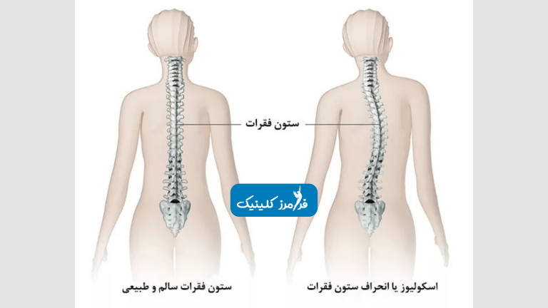 تمرینات پزشکی برای تسکین درد اسکولیوز – کششی و تقویتی