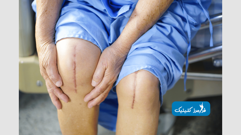 تعویض مفصل زانو چیست؟