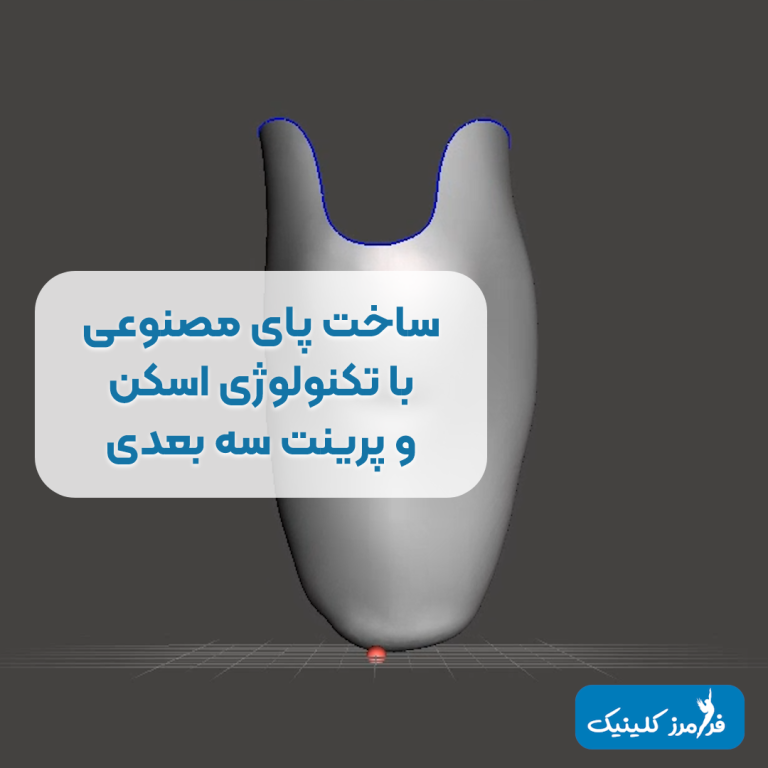 ساخت پای مصنوعی در کلینیک ما