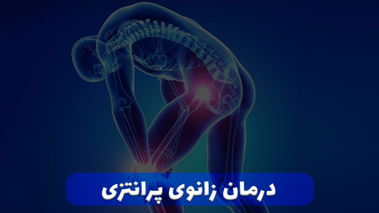 درمان زانوی پرانتزی در شیراز