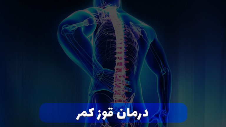 درمان قوز کمر در شیراز