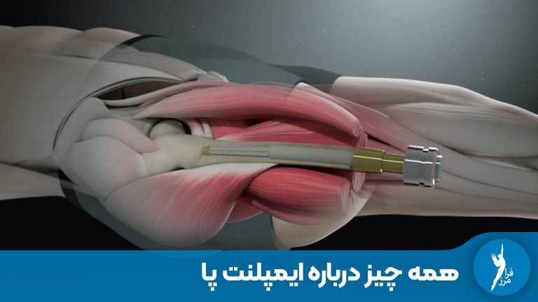 ایمپلنت پا – درمانی جدید برای افراد قطع عضو