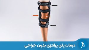 درمان پای پرانتزی بدون جراحی