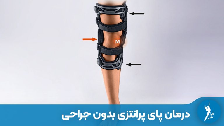 درمان پای پرانتزی بدون جراحی