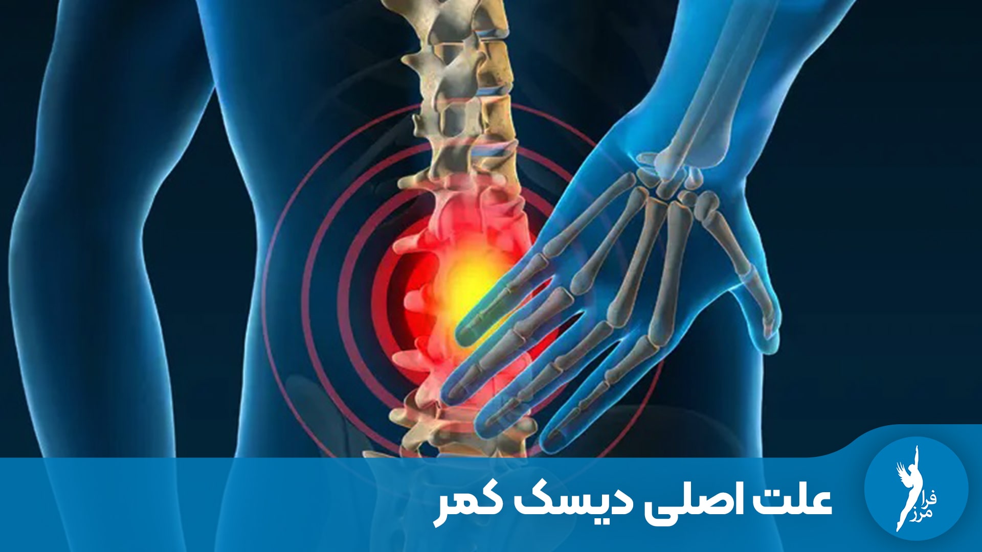 علت اصلی دیسک کمر چیست و در چه سنی بیشتر اتفاق می‌افتد؟