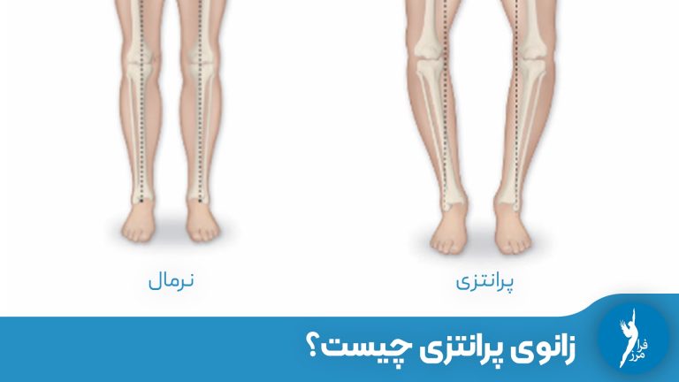 زانوی پرانتزی چیست و چرا باید درمان شود؟