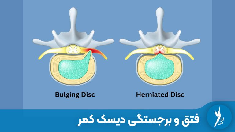 تفاوت بین فتق دیسک کمر و برجستگی دیسک کمر چیست؟