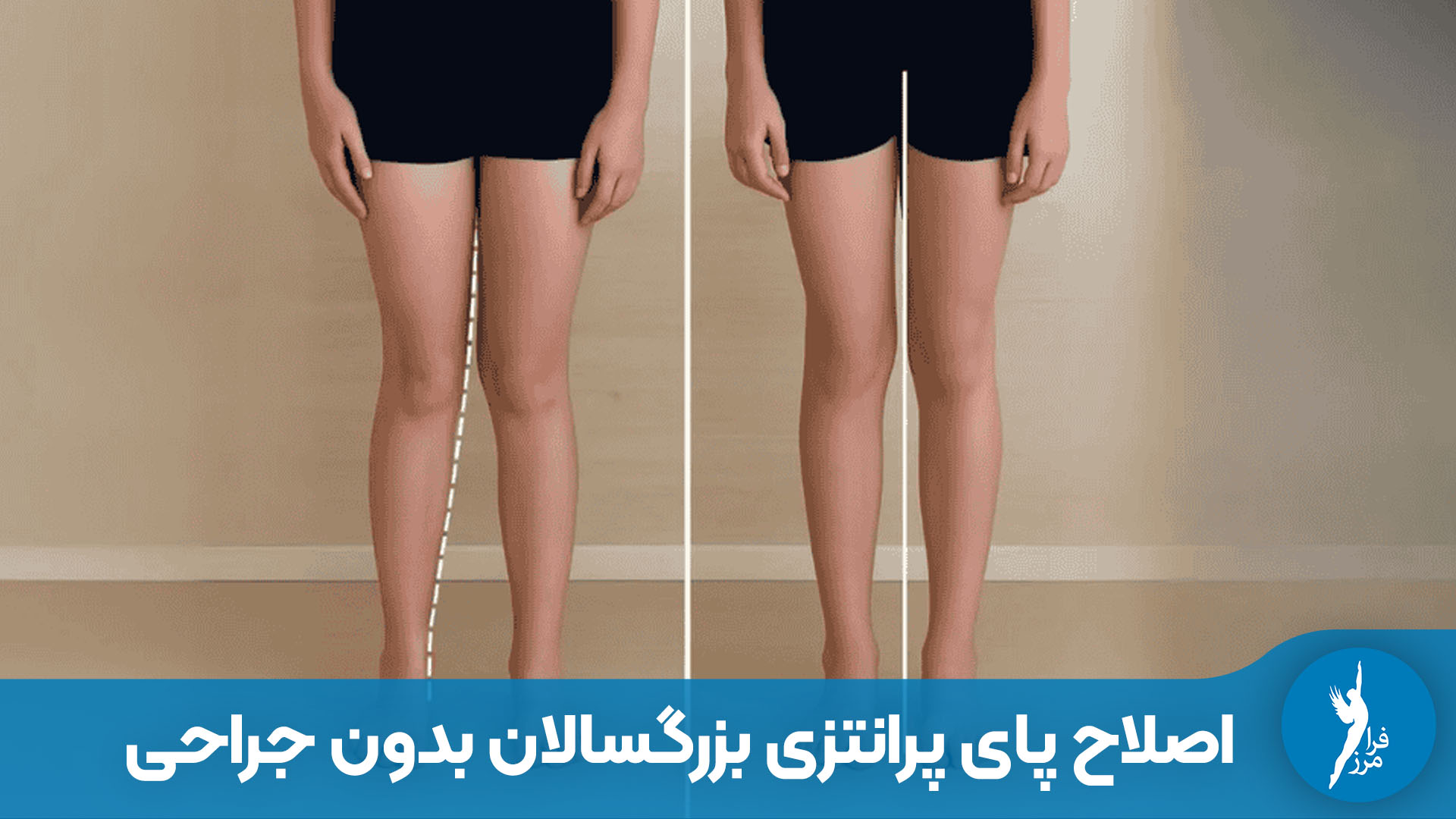 اصلاح پای پرانتزی بزرگسالان بدون جراحی
