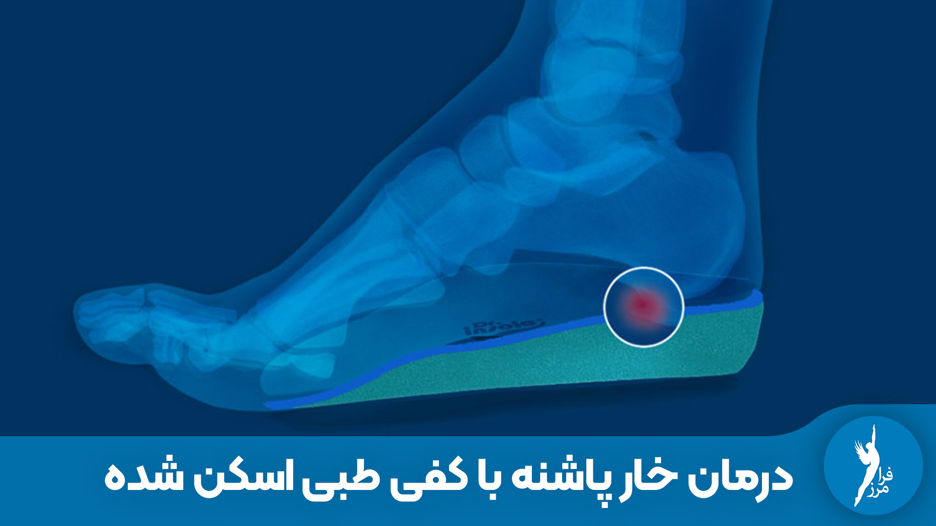 درمان خار پاشنه با کفی طبی اسکن‌ شده | چرا پد ژله‌ای کافی نیست؟