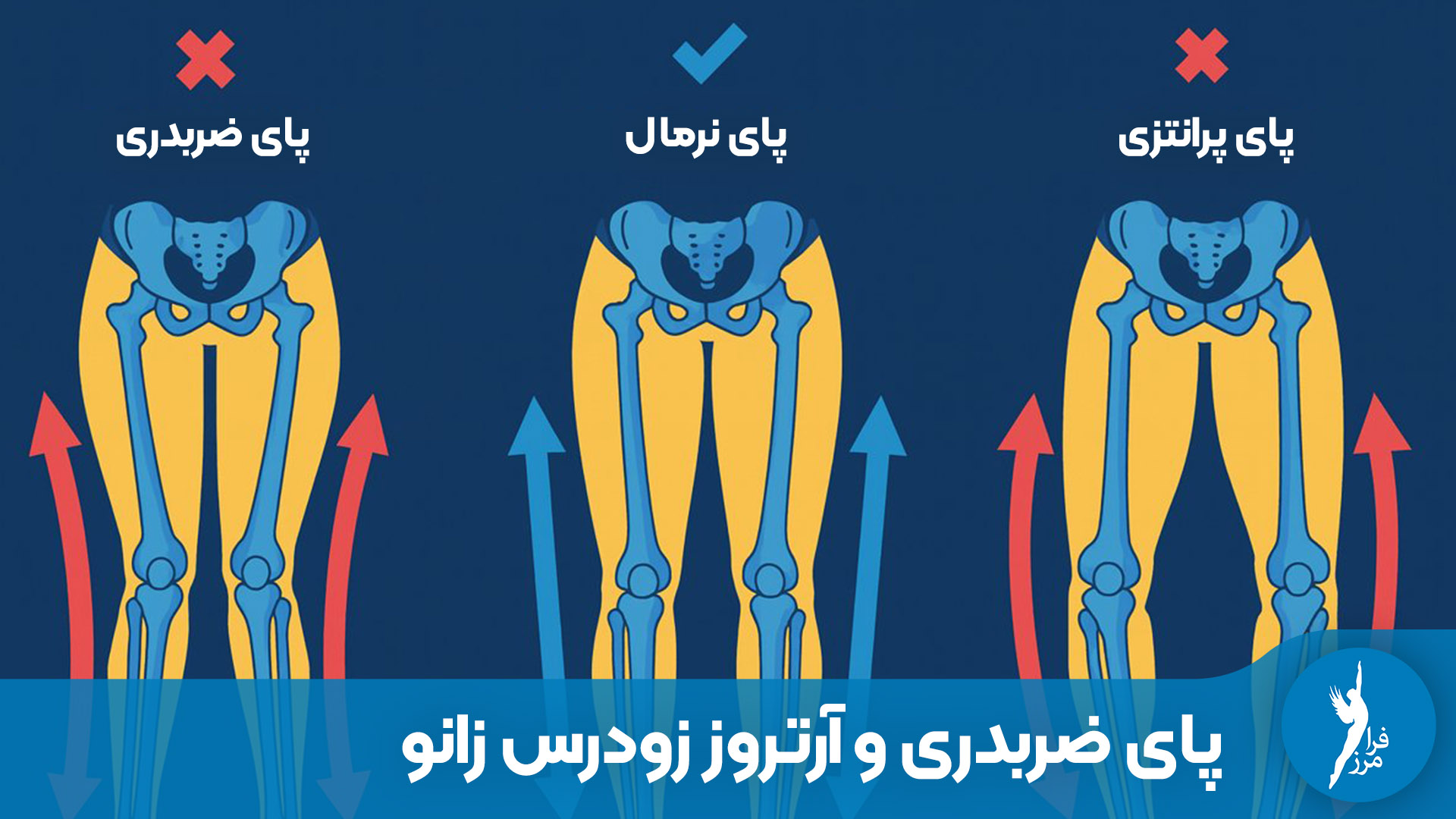 آیا پای ضربدری باعث آرتروز زودرس می‌شود؟