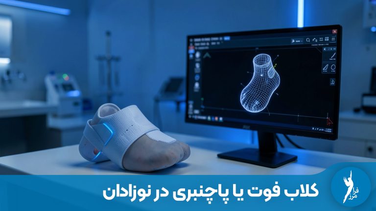 کلاب فوت یا پاچنبری در نوزادان؛ درمان قطعی با روش پونستی